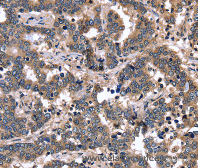 Immunohistochemistry of paraffin-embedded Human liver cancer tissue using FGFR1OP2 Polyclonal Antibody at dilution 1:40