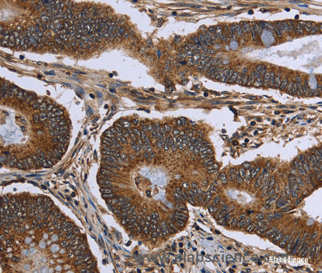 Immunohistochemistry of paraffin-embedded Human colon cancer tissue using FHIT Polyclonal Antibody at dilution 1:30