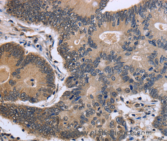 Immunohistochemistry of paraffin-embedded Human colon cancer tissue using FSTL1 Polyclonal Antibody at dilution 1:40