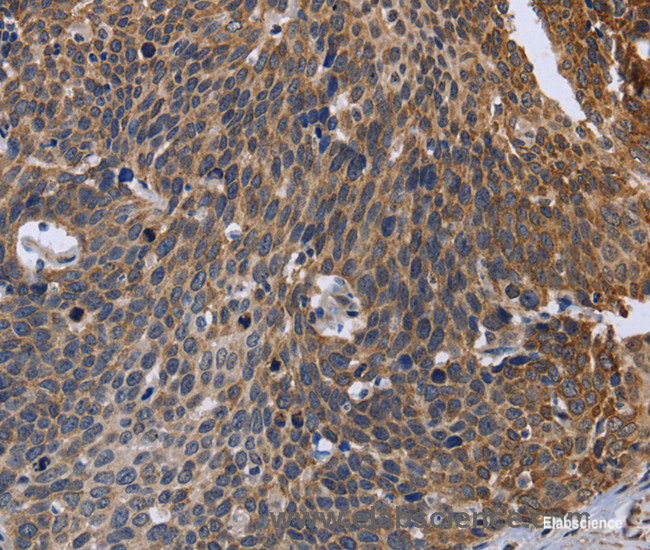 Immunohistochemistry of paraffin-embedded Human cervical cancer tissue using GABPB2 Polyclonal Antibody at dilution 1:30