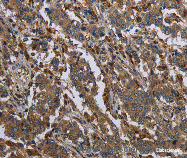 Immunohistochemistry of paraffin-embedded Human liver cancer tissue using GYS2 Polyclonal Antibody at dilution 1:40