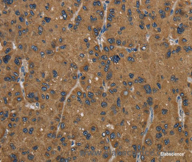 Immunohistochemistry of paraffin-embedded Human liver cancer tissue using HSD17B2 Polyclonal Antibody at dilution 1:50