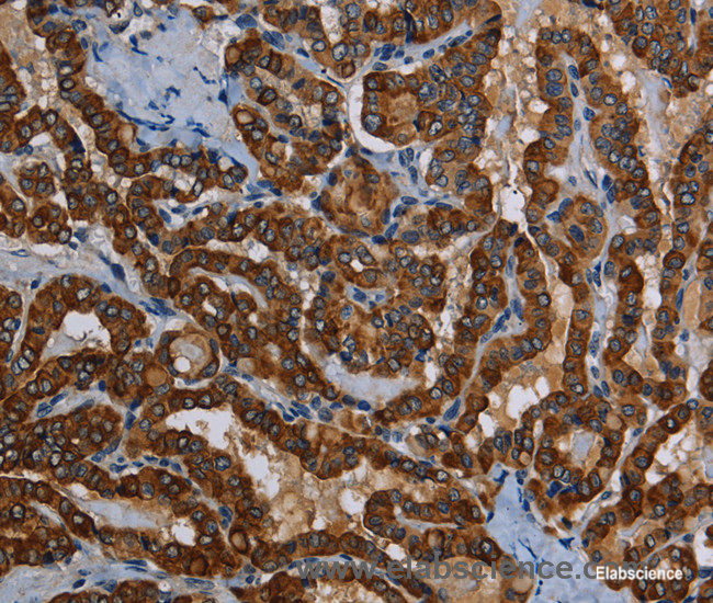 Immunohistochemistry of paraffin-embedded Human thyroid cancer tissue using PIDD1 Polyclonal Antibody at dilution 1:50