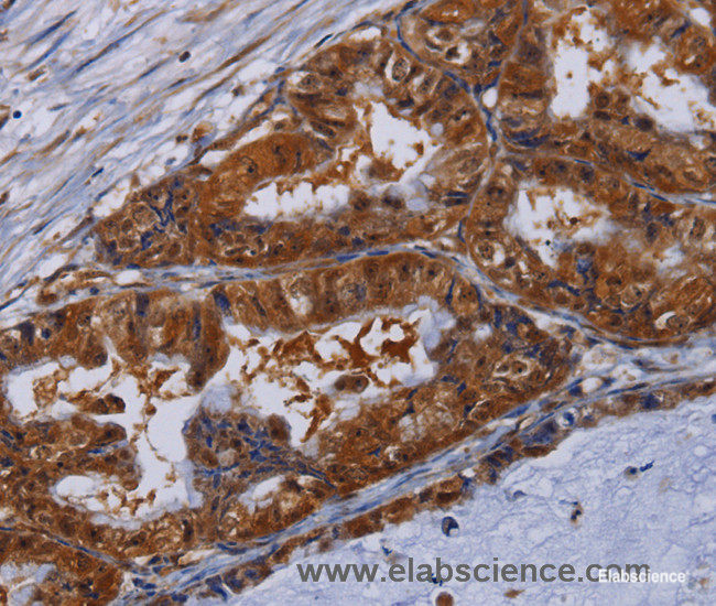 Immunohistochemistry of paraffin-embedded Human esophagus cancer tissue using MFAP3L Polyclonal Antibody at dilution 1:50