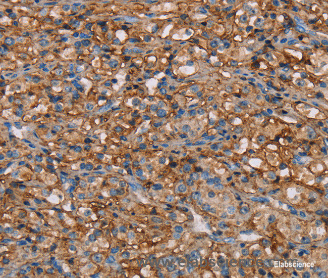 Immunohistochemistry of paraffin-embedded Human prostate cancer tissue using NEDD4L Polyclonal Antibody at dilution 1:50