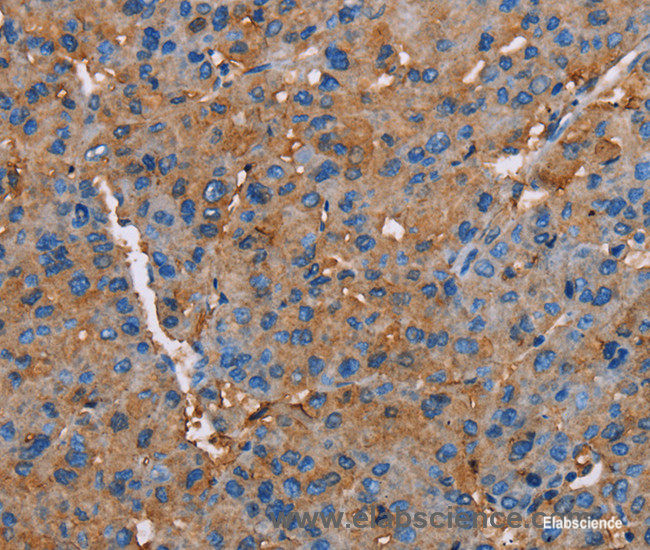 Immunohistochemistry of paraffin-embedded Human liver cancer tissue using NLGN1 Polyclonal Antibody at dilution 1:50
