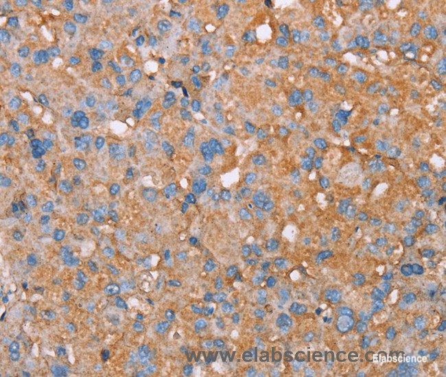 Immunohistochemistry of paraffin-embedded Human liver cancer tissue using PAGE5 Polyclonal Antibody at dilution 1:55