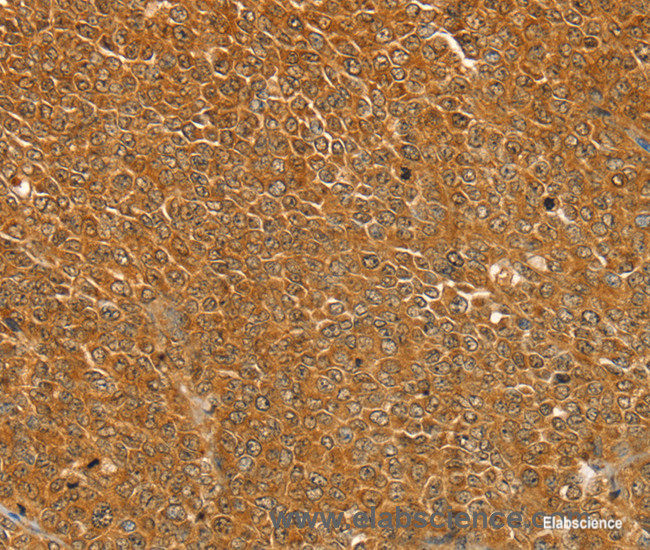 Immunohistochemistry of paraffin-embedded Human ovarian cancer tissue using ST18 Polyclonal Antibody at dilution 1:50