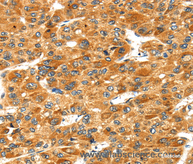 Immunohistochemistry of paraffin-embedded Human liver cancer tissue using STXBP4 Polyclonal Antibody at dilution 1:40