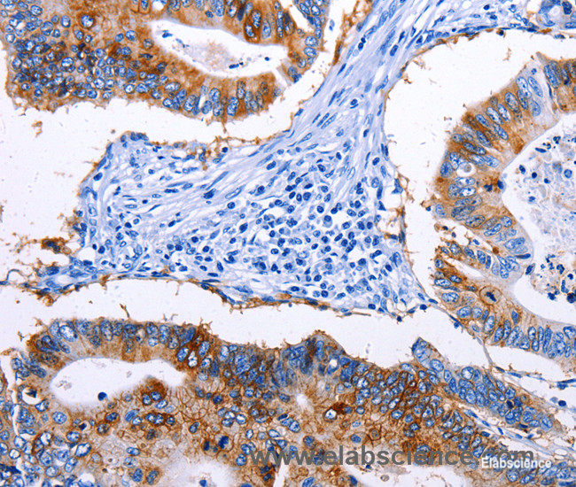 Immunohistochemistry of paraffin-embedded Human colon cancer tissue using EPCAM Polyclonal Antibody at dilution 1:45
