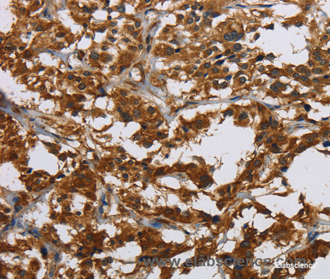 Immunohistochemistry of paraffin-embedded Human thyroid cancer tissue using Claudin 2 Polyclonal Antibody at dilution 1:30