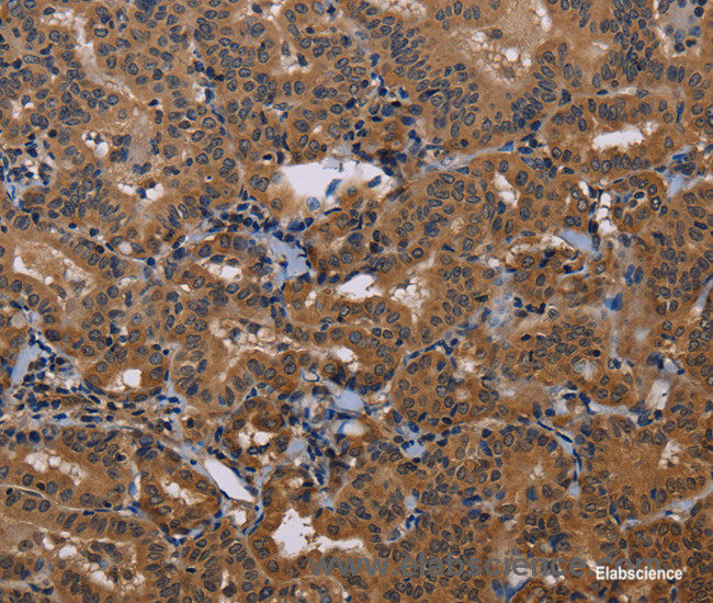 Immunohistochemistry of paraffin-embedded Human thyroid cancer tissue using GRK1 Polyclonal Antibody at dilution 1:30