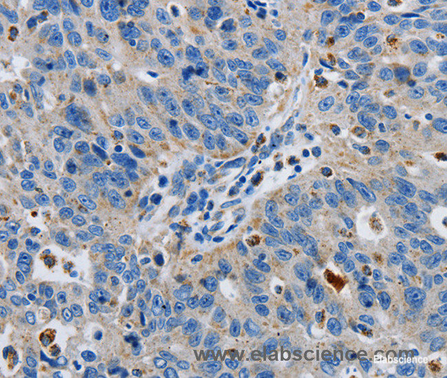 Immunohistochemistry of paraffin-embedded Human ovarian cancer tissue using GRIA3 Polyclonal Antibody at dilution 1:50