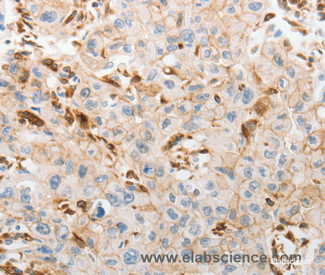 Immunohistochemistry of paraffin-embedded Human lung cancer tissue using SLC15A2 Polyclonal Antibody at dilution 1:60