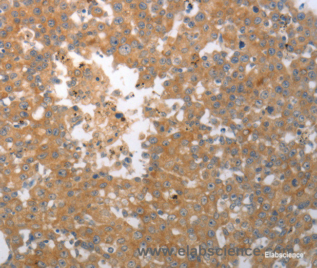 Immunohistochemistry of paraffin-embedded Human breast cancer tissue using SHH Polyclonal Antibody at dilution 1:40