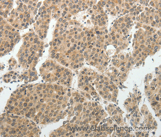 Immunohistochemistry of paraffin-embedded Human liver cancer tissue using SOCS7 Polyclonal Antibody at dilution 1:30