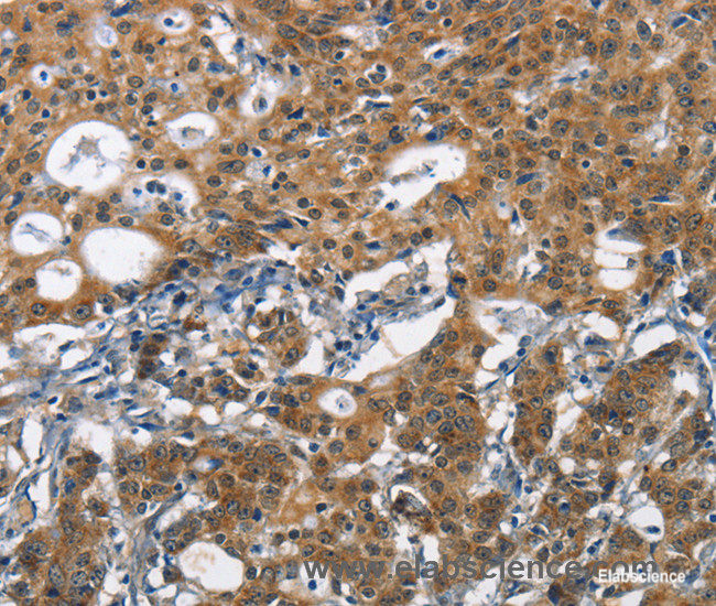Immunohistochemistry of paraffin-embedded Human gasrtic cancer tissue using DCC Polyclonal Antibody at dilution 1:70