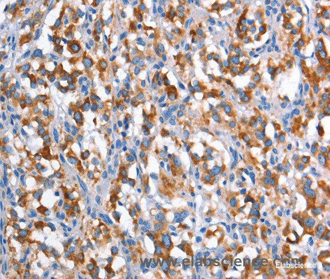 Immunohistochemistry of paraffin-embedded Human thyroid cancer tissue using CD226 Polyclonal Antibody at dilution 1:60