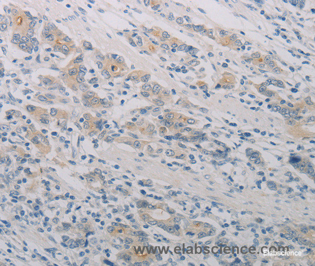 Immunohistochemistry of paraffin-embedded Human gasrtic cancer tissue using PTAFR Polyclonal Antibody at dilution 1:70