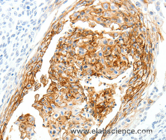 Immunohistochemistry of paraffin-embedded Human cervical cancer tissue using SEMA3D Polyclonal Antibody at dilution 1:40