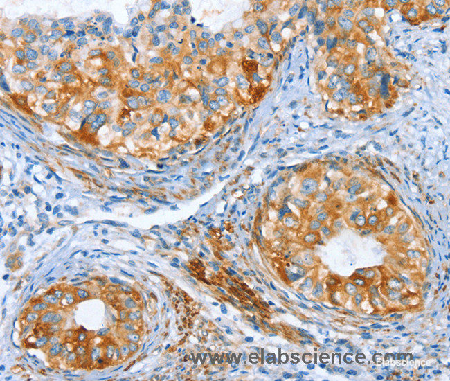 Immunohistochemistry of paraffin-embedded Human cervical cancer tissue using AIP Polyclonal Antibody at dilution 1:80