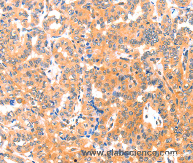Immunohistochemistry of paraffin-embedded Human thyroid cancer tissue using THBS1 Polyclonal Antibody at dilution 1:60