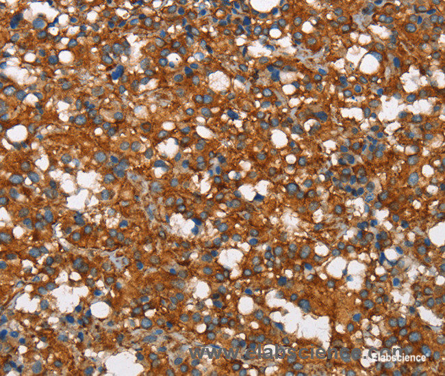 Immunohistochemistry of paraffin-embedded Human thyroid cancer tissue using COX5A Polyclonal Antibody at dilution 1:40