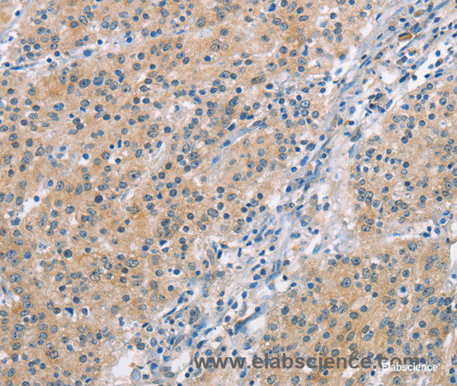 Immunohistochemistry of paraffin-embedded Human gasrtic cancer tissue using MCL1 Polyclonal Antibody at dilution 1:60