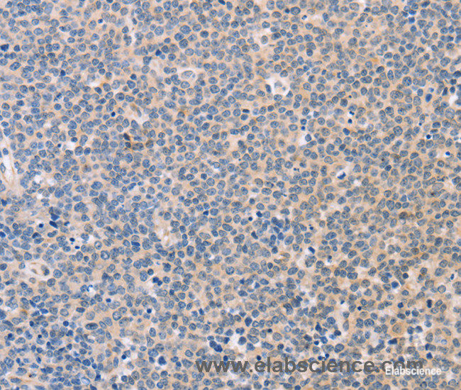 Immunohistochemistry of paraffin-embedded Human Lymphoma tissue using CD56 Polyclonal Antibody at dilution 1:30