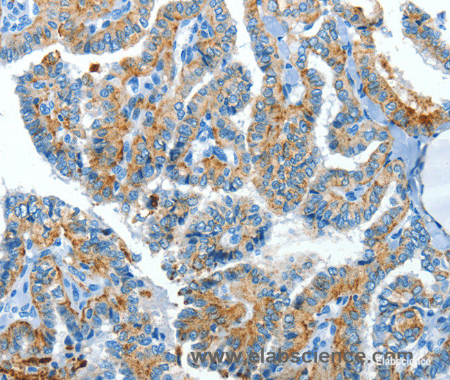 Immunohistochemistry of paraffin-embedded Human thyroid cancer tissue using CLPTM1L Polyclonal Antibody at dilution 1:60