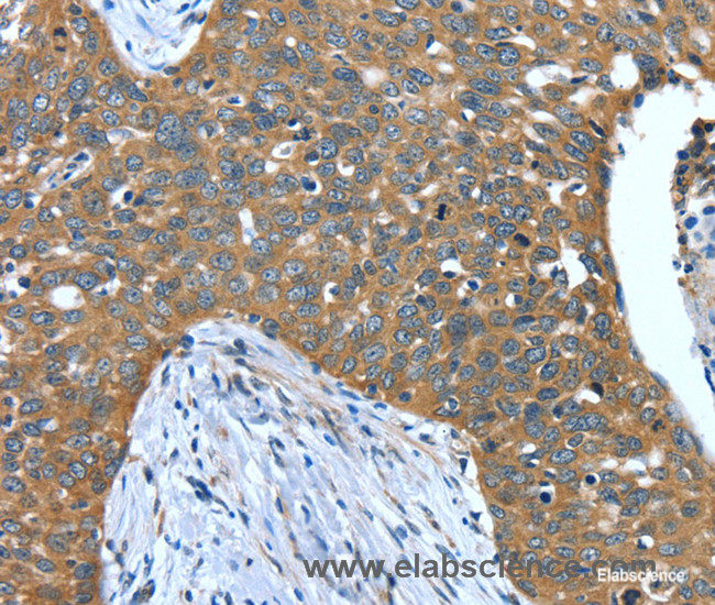 Immunohistochemistry of paraffin-embedded Human cervical cancer tissue using DTX1 Polyclonal Antibody at dilution 1:40