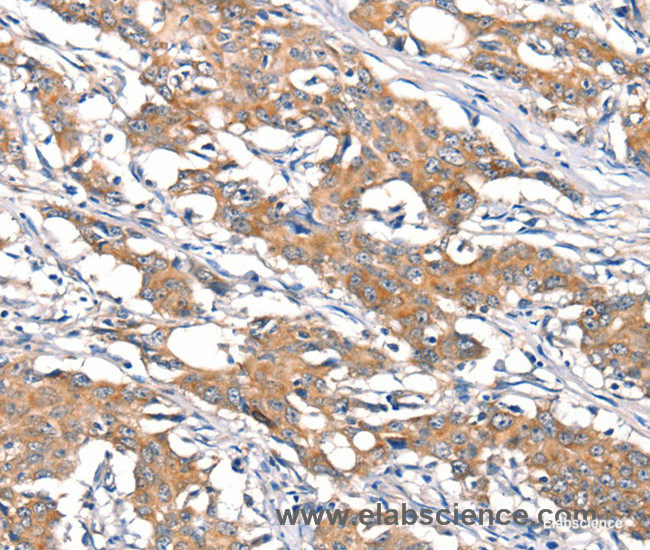 Immunohistochemistry of paraffin-embedded Human gasrtic cancer tissue using DSC1 Polyclonal Antibody at dilution 1:40