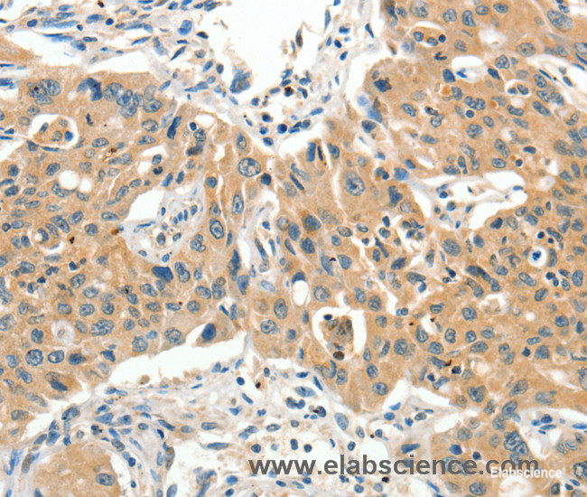 Immunohistochemistry of paraffin-embedded Human lung cancer tissue using SLC11A2 Polyclonal Antibody at dilution 1:65