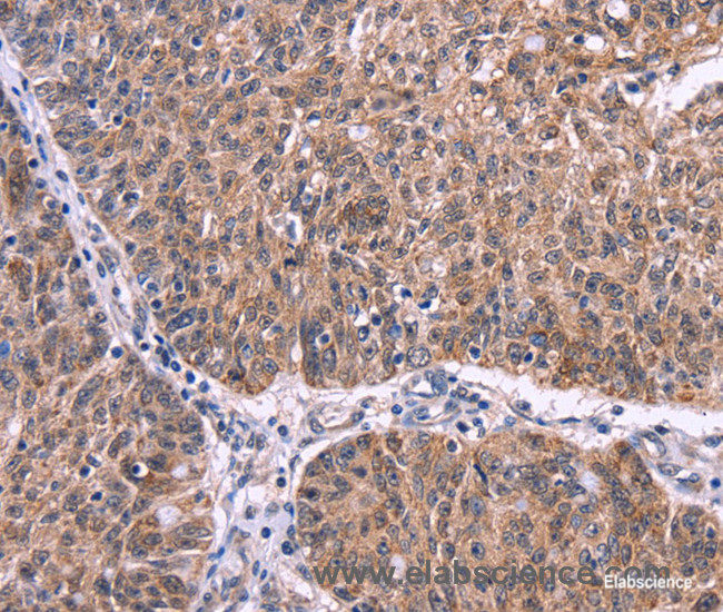 Immunohistochemistry of paraffin-embedded Human ovarian cancer tissue using Ephrin A5 Polyclonal Antibody at dilution 1:40