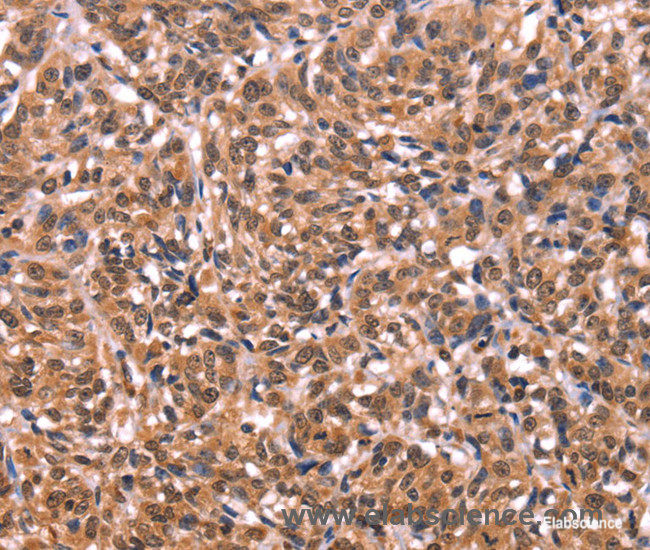 Immunohistochemistry of paraffin-embedded Human esophagus cancer tissue using ESRRB Polyclonal Antibody at dilution 1:40