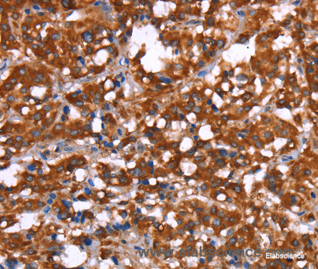 Immunohistochemistry of paraffin-embedded Human thyroid cancer tissue using GAGE12I Polyclonal Antibody at dilution 1:30