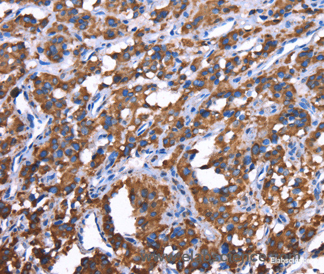 Immunohistochemistry of paraffin-embedded Human thyroid cancer tissue using GREB1 Polyclonal Antibody at dilution 1:50