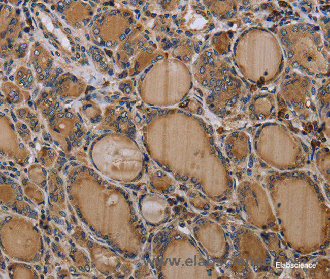 Immunohistochemistry of paraffin-embedded Human thyroid cancer tissue using NLRP4 Polyclonal Antibody at dilution 1:30