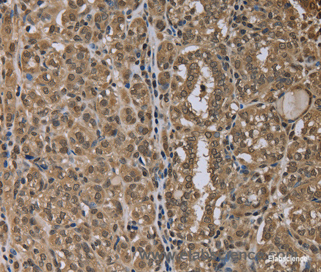 Immunohistochemistry of paraffin-embedded Human thyroid cancer tissue using NLRP6 Polyclonal Antibody at dilution 1:40