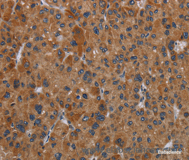 Immunohistochemistry of paraffin-embedded Human liver cancer tissue using OMG Polyclonal Antibody at dilution 1:30