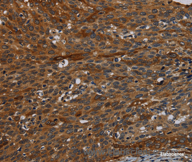 Immunohistochemistry of paraffin-embedded Human cervical cancer tissue using IVL Polyclonal Antibody at dilution 1:50
