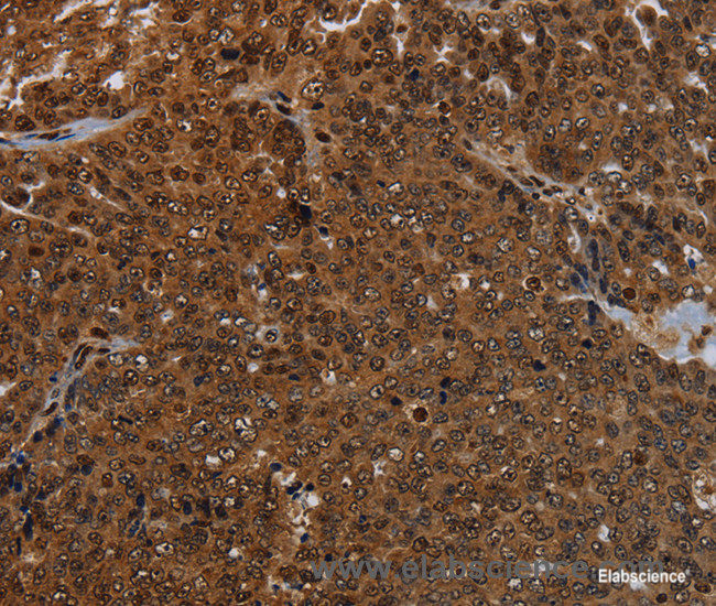 Immunohistochemistry of paraffin-embedded Human ovarian cancer tissue using KDM4B Polyclonal Antibody at dilution 1:50