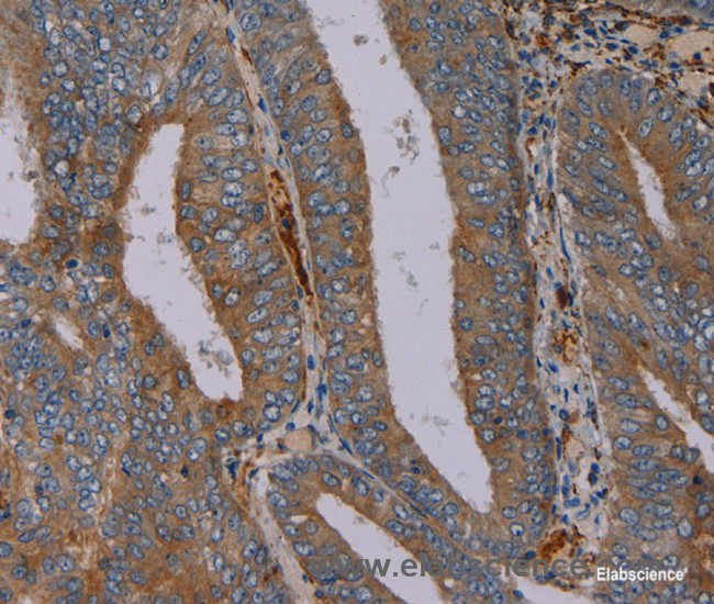 Immunohistochemistry of paraffin-embedded Human colon cancer tissue using PYY Polyclonal Antibody at dilution 1:40