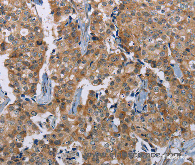 Immunohistochemistry of paraffin-embedded Human breast cancer tissue using PLXNA4 Polyclonal Antibody at dilution 1:50