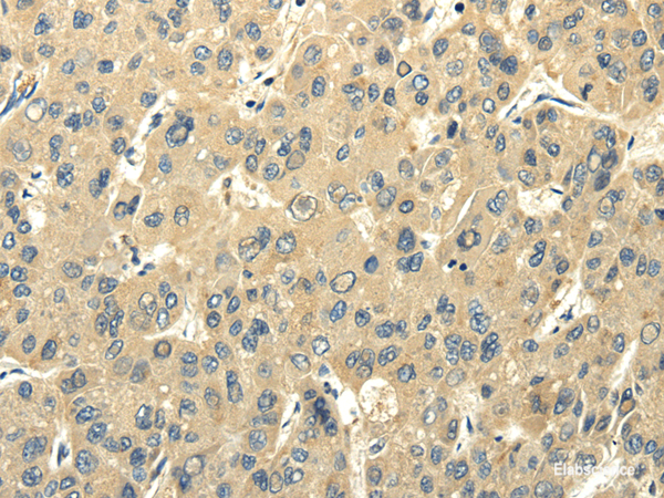 Immunohistochemistry of paraffin-embedded Human liver cancer using PMP2 Polyclonal Antibody at dilution of 1/25