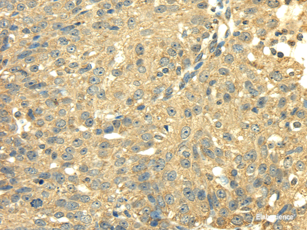 Immunohistochemistry of paraffin-embedded Human breast cancer using SDHA Polyclonal Antibody at dilution of 1/40