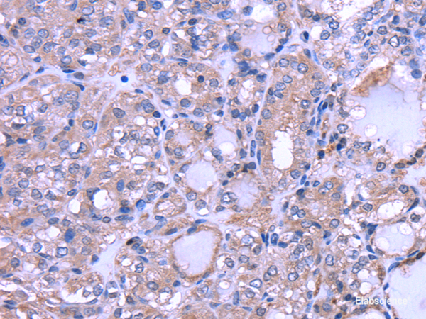 Immunohistochemistry of paraffin-embedded Human thyroid cancer using THRSP Polyclonal Antibody at dilution of 1/30
