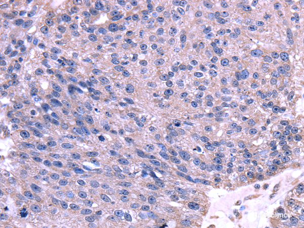 Immunohistochemistry of paraffin-embedded Human breast cancer using TRIM14 Polyclonal Antibody at dilution of 1/35