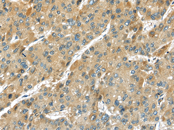 Immunohistochemistry of paraffin-embedded Human liver cancer using TMPRSS11D Polyclonal Antibody at dilution of 1/35