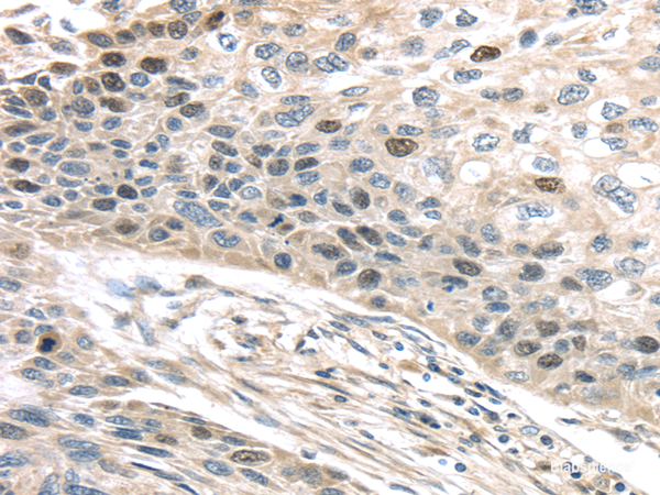 Immunohistochemistry of paraffin-embedded Human esophagus cancer using TPX2 Polyclonal Antibody at dilution of 1/40